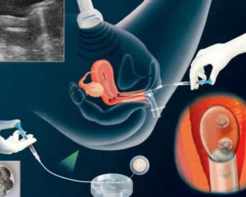 北京供精人工授精条件分析！北京供精助孕指南介绍